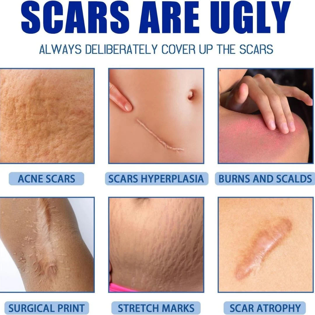 SCAR REMOVAL CREAM PACK OF 1